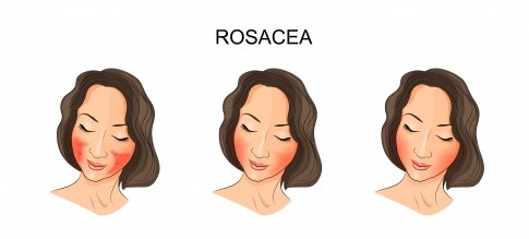 Rosacea Creme hilft gegen die Symptome