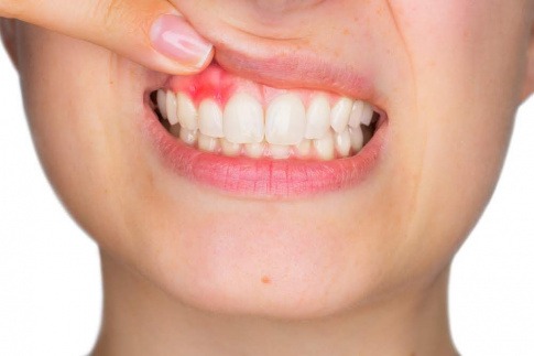 Wenn das Zahnfleisch blutet, ist das ein erstes Anzeichen für eine Entzündung. 