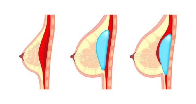 Eine Grafik zeigt, wo die Implantate für eine Brustvergrößerung liegen