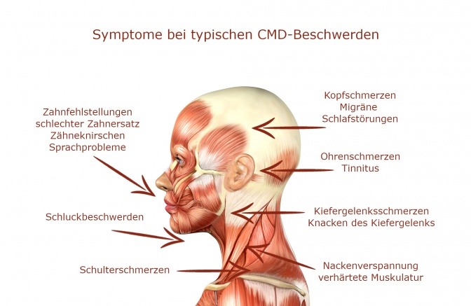 Grafik zeigt die Symptome von CMD im Kopfbereich