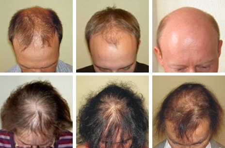 Auf einer Collage sieht man Männer und Frauen mit diffusem Haarausfall