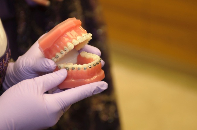 Eine Frau hält ein Modell eines Gebisses mit Damon Brackets