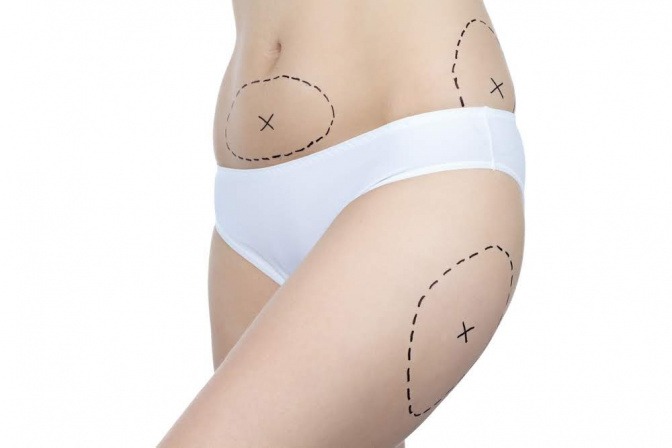 Besonders beliebt sind Fettabsaugungen am Bauch und an den Beinen. 