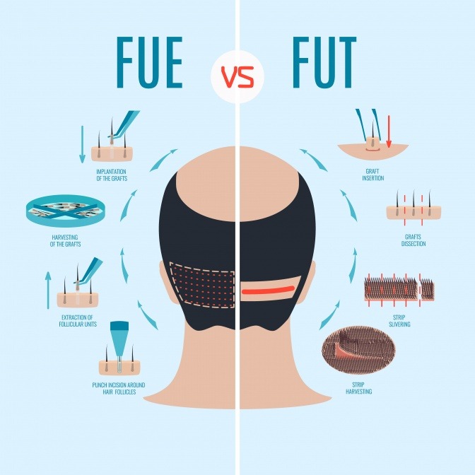 Schema von FUE- und FUT-Haartransplantation