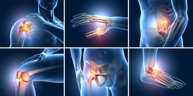 Eine Grafik zeigt die Gelenke, die bei Arthrose Schmerzen haben