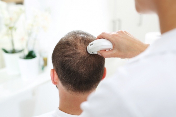 Bei einem Mann wird eine Haaranalyse wegen Haarausfall durchgeführt