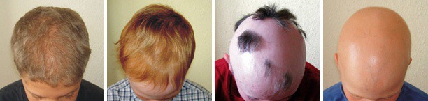 Ein Bild zeigt Haarausfall bei Kindern