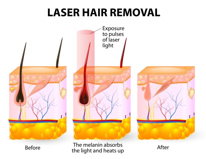 Grafik zeigt Haarentfernung mit Laser