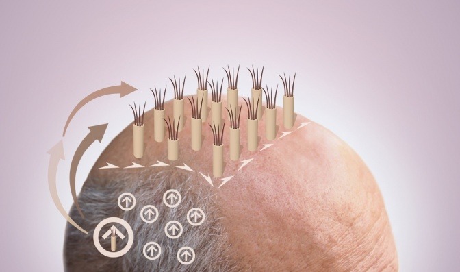 Eine Grafik zeigt eine Haartransplantation mit Eigenhaar