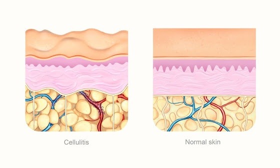 Eine Grafik zeigt den Aufbau der Haut bei Cellulite