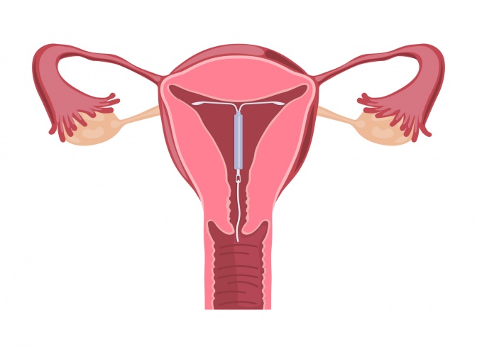 Eine Zeichnung zeigt eine Hormonspirale in der Gebärmutter