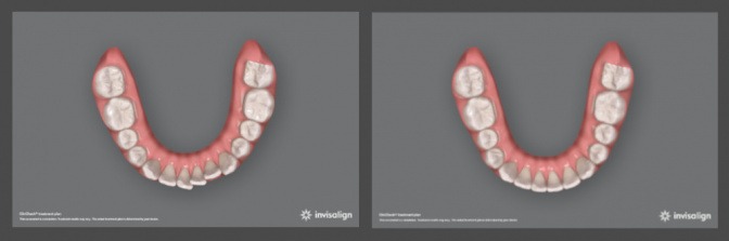 Vorher-Nachher-Bilder bei der Behandlung mit Invisalign