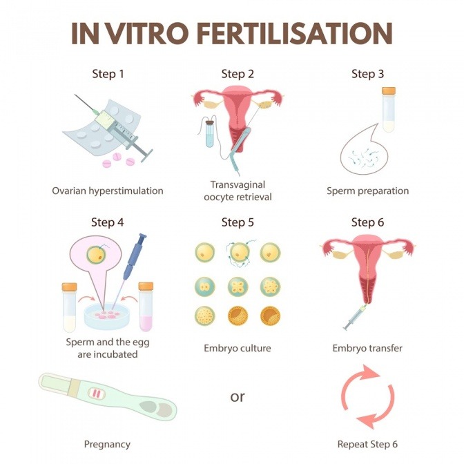 Eine Grafik zeigt, wie eine Invitrofertilisation (IVF) funktioniert