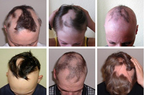 Auf einer Collage sieht man Männer und Frauen mit kreisrundem Haarausfall
