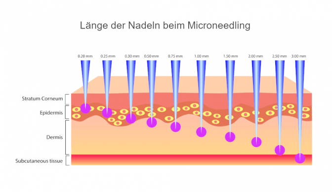 Eine Grafik zeigt die Länge der Nadeln beim Microneedling