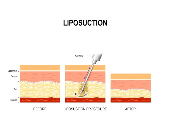 Bei einer Liposuktion werden die kompletten Fettzellen entfernt. 