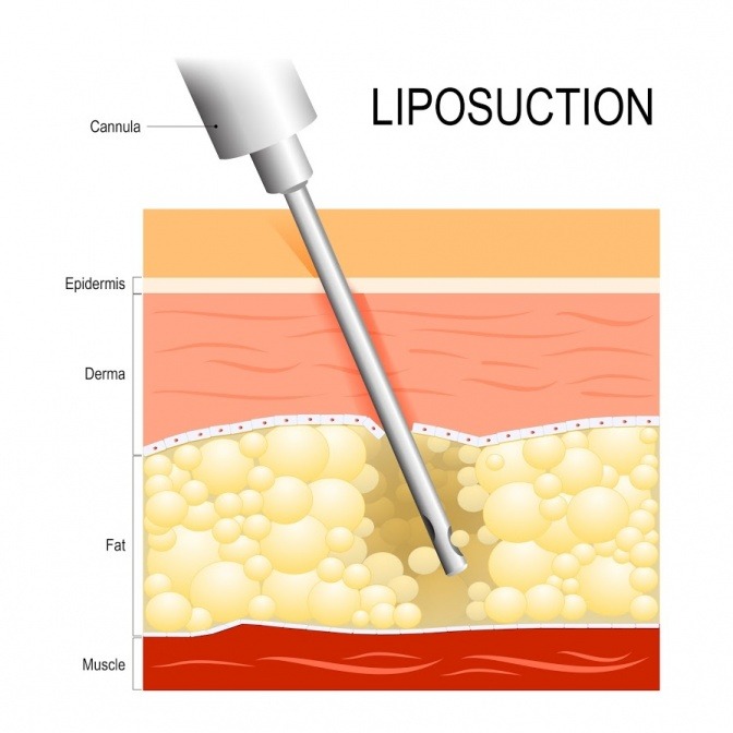 Eine Grafik zeigt, wie eine Liposuktion bei einem Lipödem funktioniert