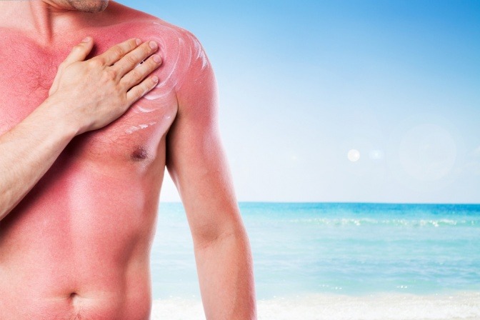 Ein Mann mit einem Sonnenbrand reibt sich die Schulter