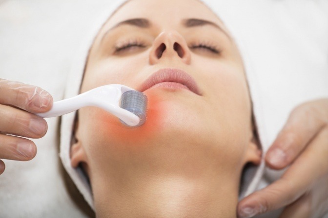 Eine Frau bekommt eine Micro-Needling-Behandlung