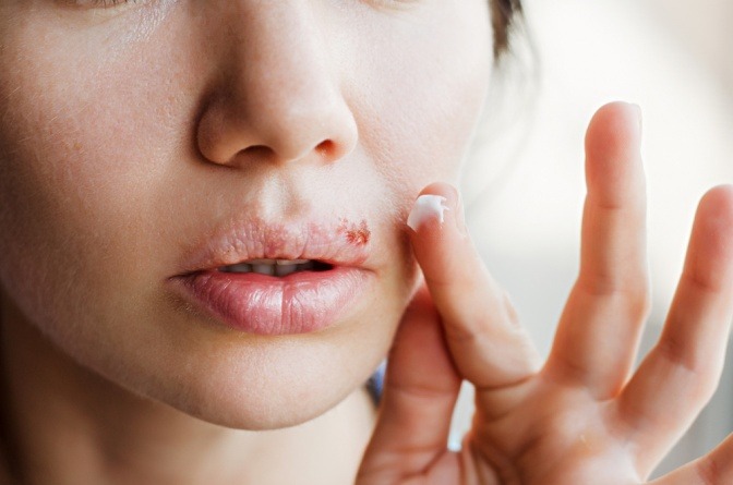 Junge Frau macht Creme auf Lippenherpes.