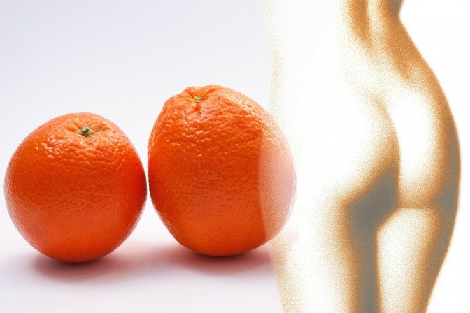 Eine Frau hat Orangenhaut (Cellulite)