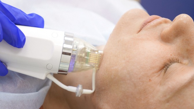 Microneedling im Gesicht