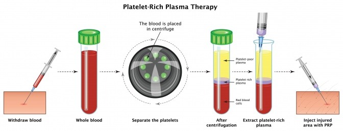 Grafik zeigt die Anreicherung des Blutes mit der PRP-Methode