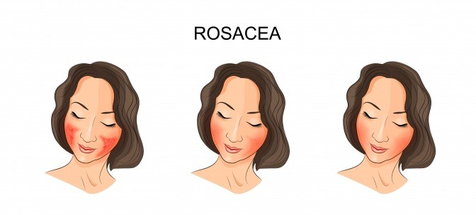 Grafik von Rosacea