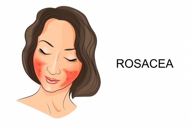 Eine Frau hat Rosacea