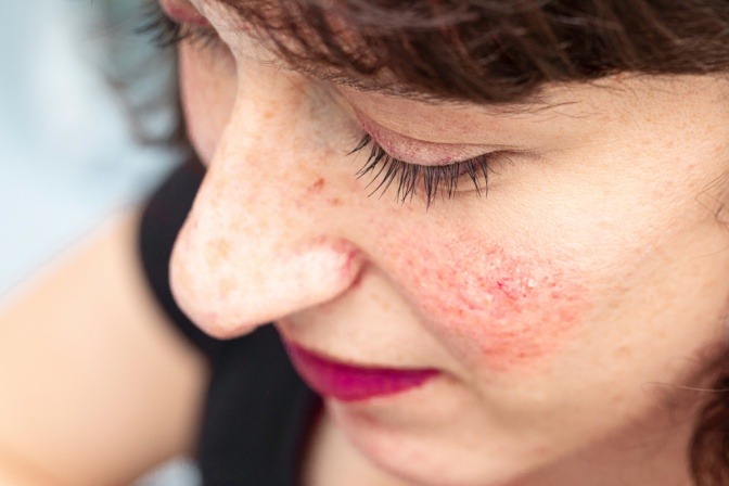 Frau mit Rosacea