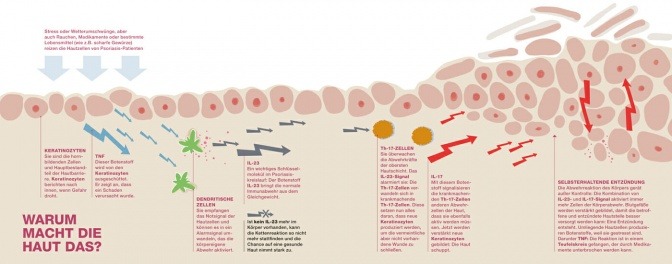 Eine Grafik zeigt, was Schuppenflechte mit der Haut macht