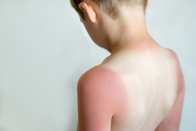 Sonnenbrand auf dem Rücken eines Kindes