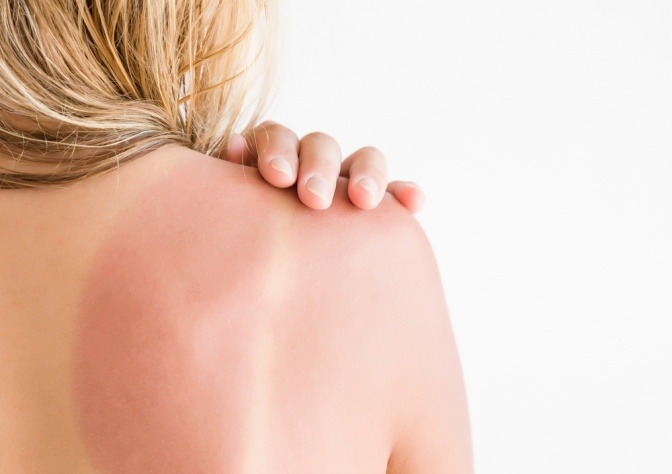Frau mit Sonnenbrand auf der Schulter