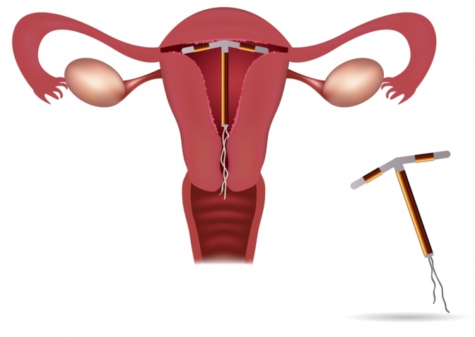 Eine Grafik zeigt eine Spirale und die Lage in der Gebärmutter
