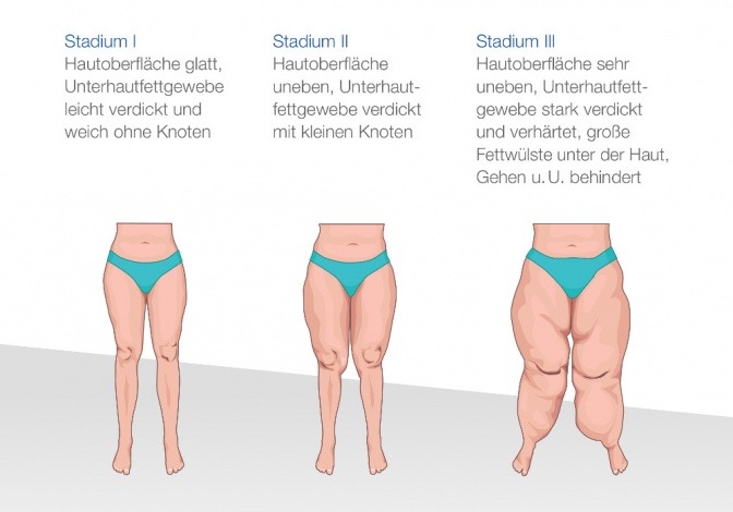 Lipödem Vererbbar Lipödem Vererbbar