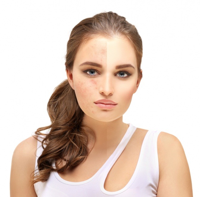 Mit Camouflage Make up kann man unreine Haut überdecken