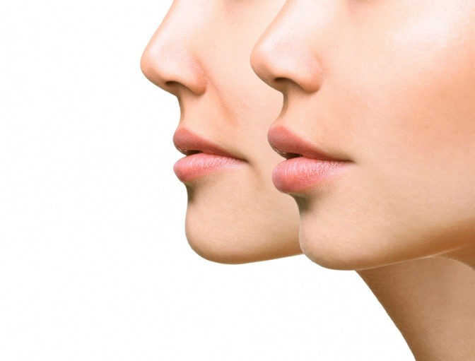 Ein Vorher-Nachher-Vergleich einer Lippen-Behandlung ist abgebildet