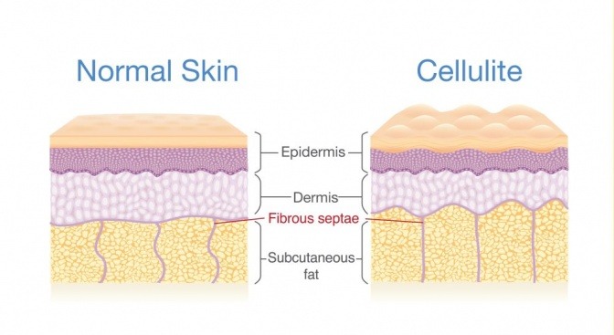Grafik zeigt den Aufbau der Haut bei Cellulite
