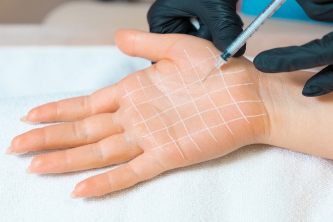 Botoxbehandlung gegen schwitzige Hände