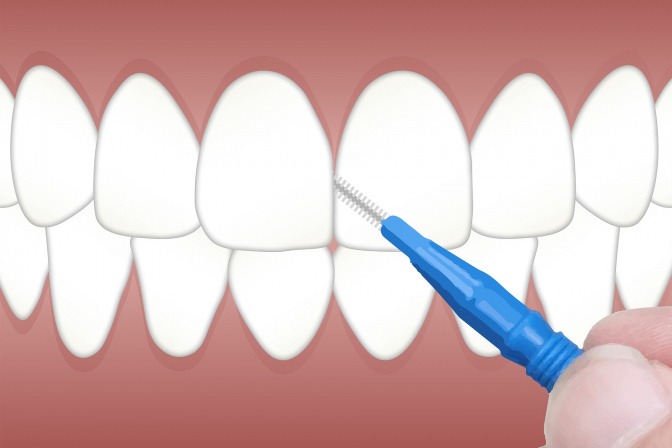 Die richtige Technik beim Zähneputzen beugt Karies vor. 