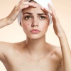 Akne Creme ist die erste Hilfe gegen Hautunreinheiten