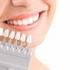 In-Office-Bleaching macht die Zähne um mehrere Nuancen weißer. 