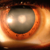Ein Auge mit der Krankheit Grauer Star (Katarakt) ist zu sehen