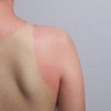 Frau mit Sonnenbrand auf der Haut