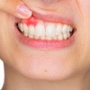 Wenn das Zahnfleisch blutet, ist das ein erstes Anzeichen für eine Entzündung. 