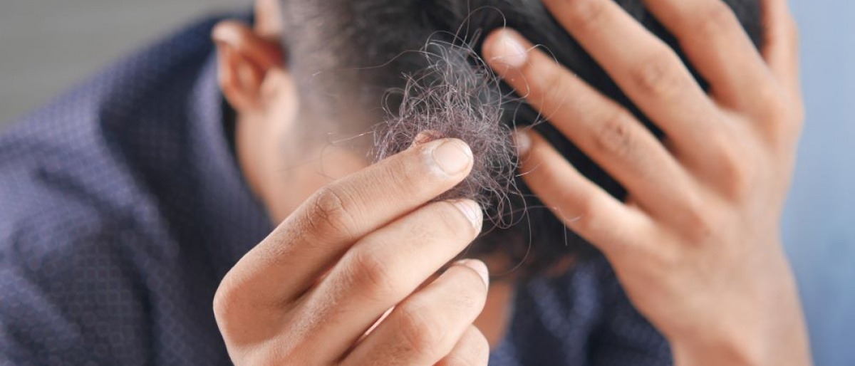 Ein Mann hält ein Büschel ausgefallener Haare in der Hand