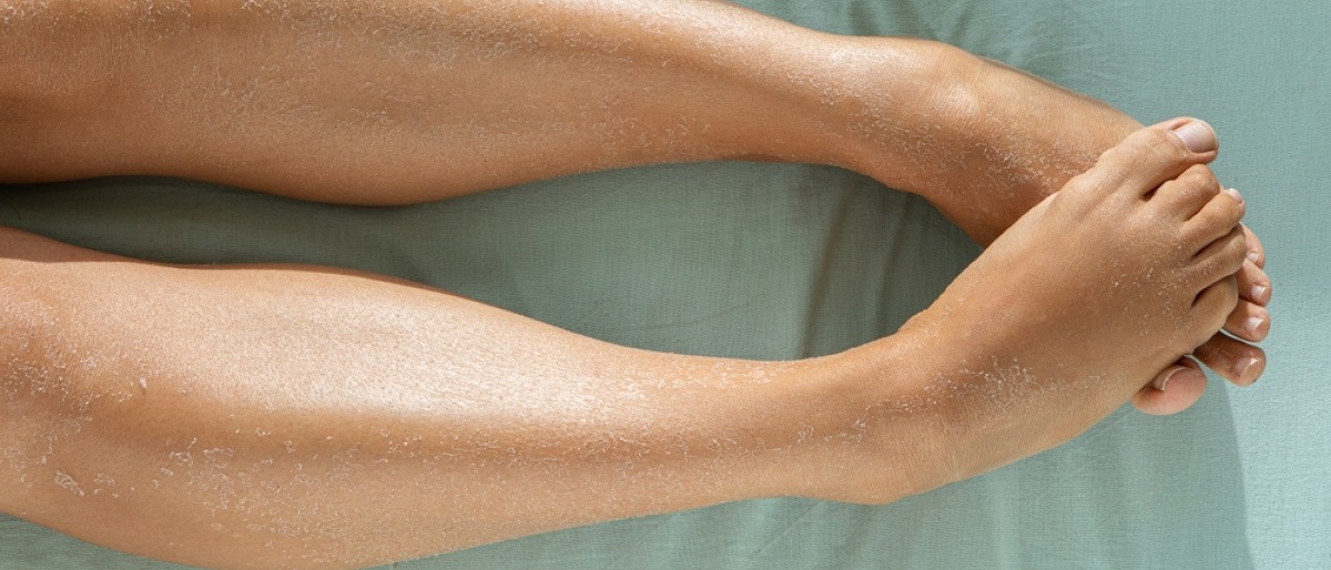 extrem trockene Haut an den Beinen einer Frau