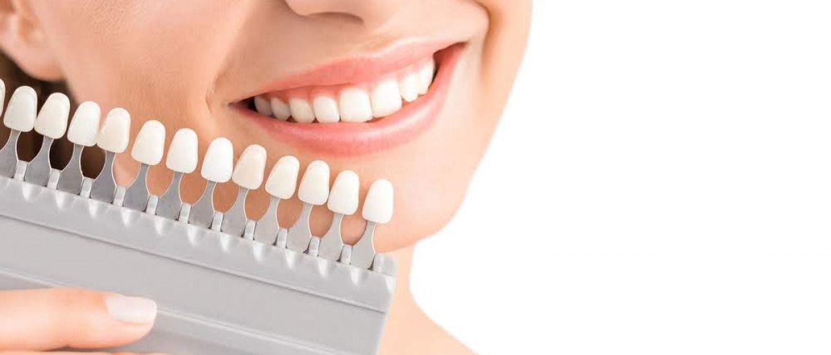 In-Office-Bleaching macht die Zähne um mehrere Nuancen weißer. 