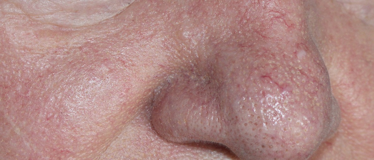 Ein Gesicht mit Couperose ist zu sehen