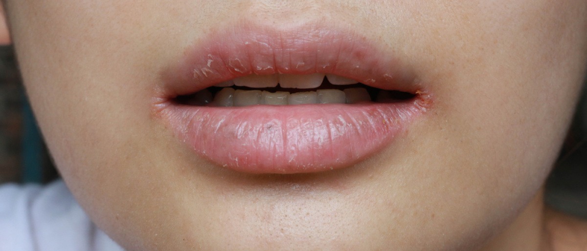 Mund mit eingerissenen Mundwinkeln und spröden Lippen